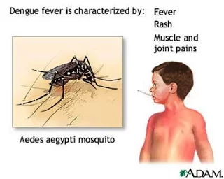 Dengue fever_plasnje_symptoms-785617.webp