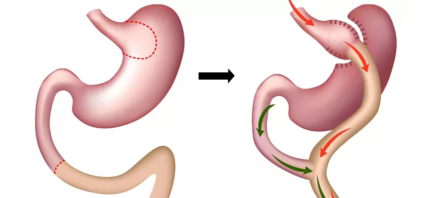 Gastric-Bypass.png