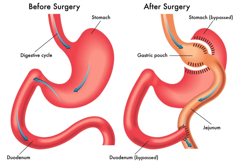 Gastric_Bypass_Illustration2.jpg